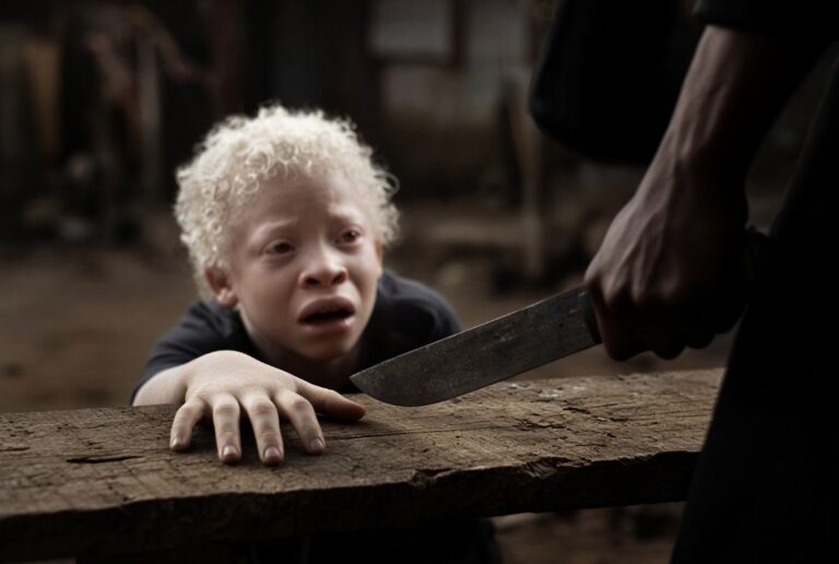 Albinism should never make someone a target